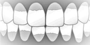 Zahnstein auf Zähnen.