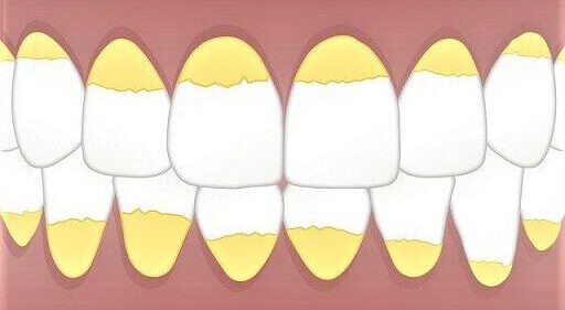 Zahnstein – wie entsteht er, wie bekämpft man ihn?
