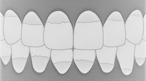 Zahnstein – wie entsteht er, wie bekämpft man ihn?