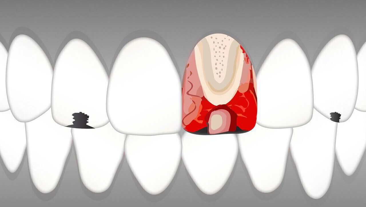 Pulpitis: Wie sie entsteht und was hilft