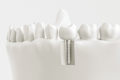 Zahnimplantat im Kiefermodell zur Darstellung moderner Implantologie und festen Zahnersatzes in der Zahnarztpraxis Dr. Tolk in Kreuzau